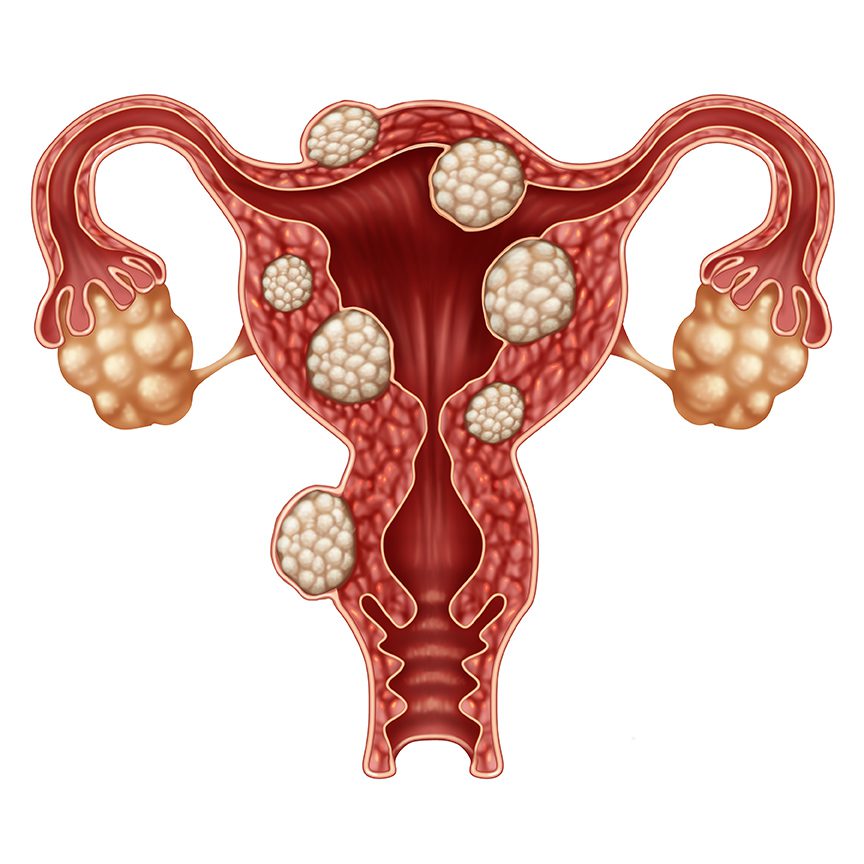 infertilidade feminina miomas