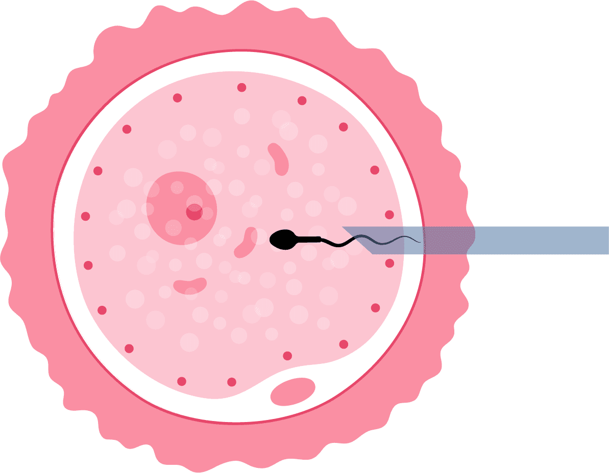 injeção intracitoplasmática de espermatozoide ICSI